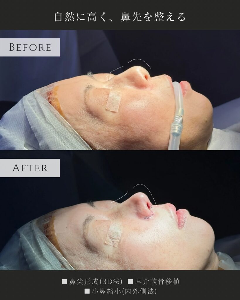 鼻尖形成と耳介軟骨移植と小鼻縮小の症例写真 (10)