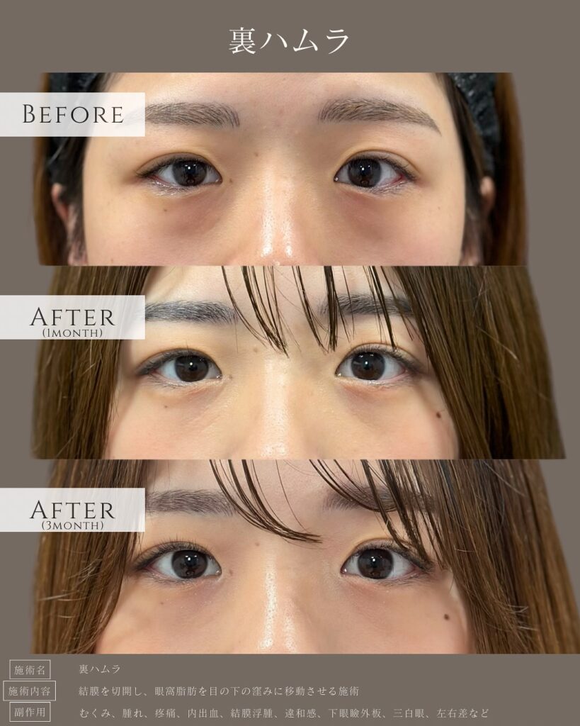 裏ハムラ法の症例写真 (17)