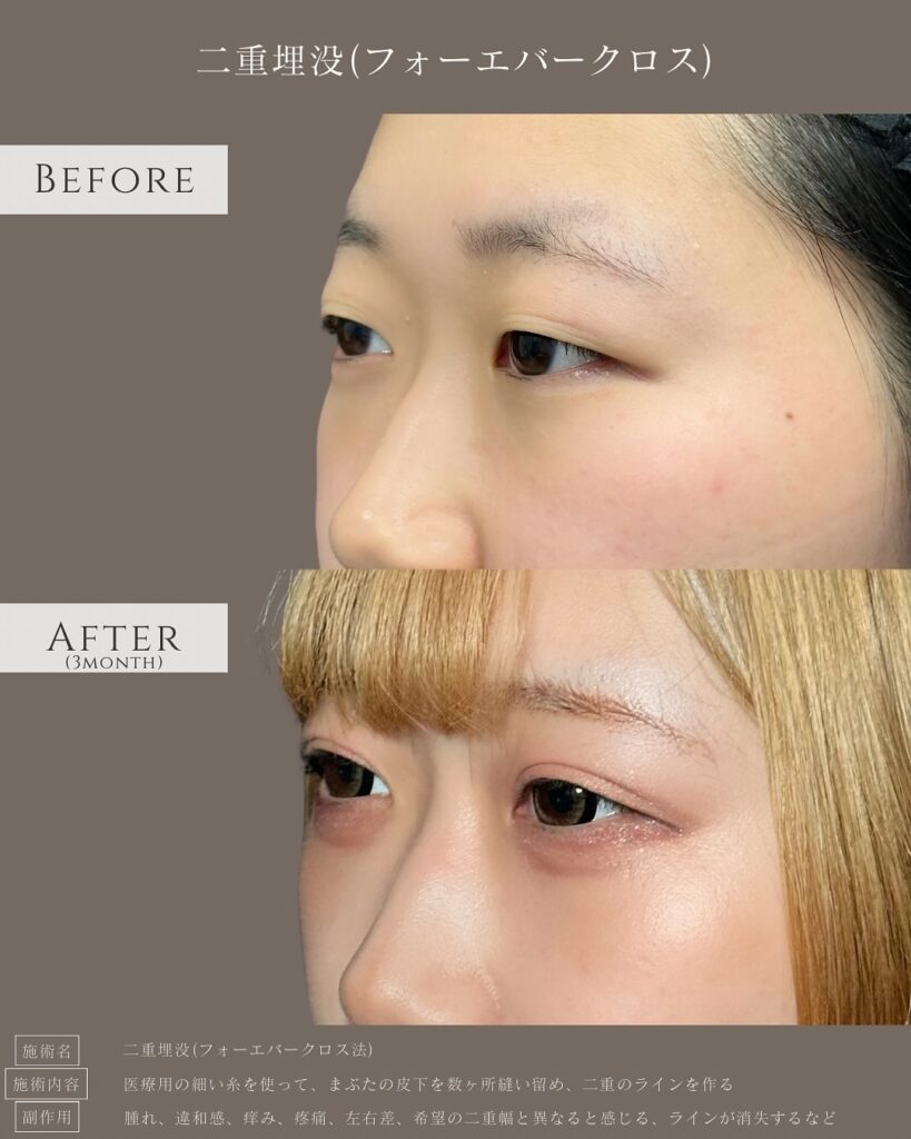 埋没法の症例写真 (6)