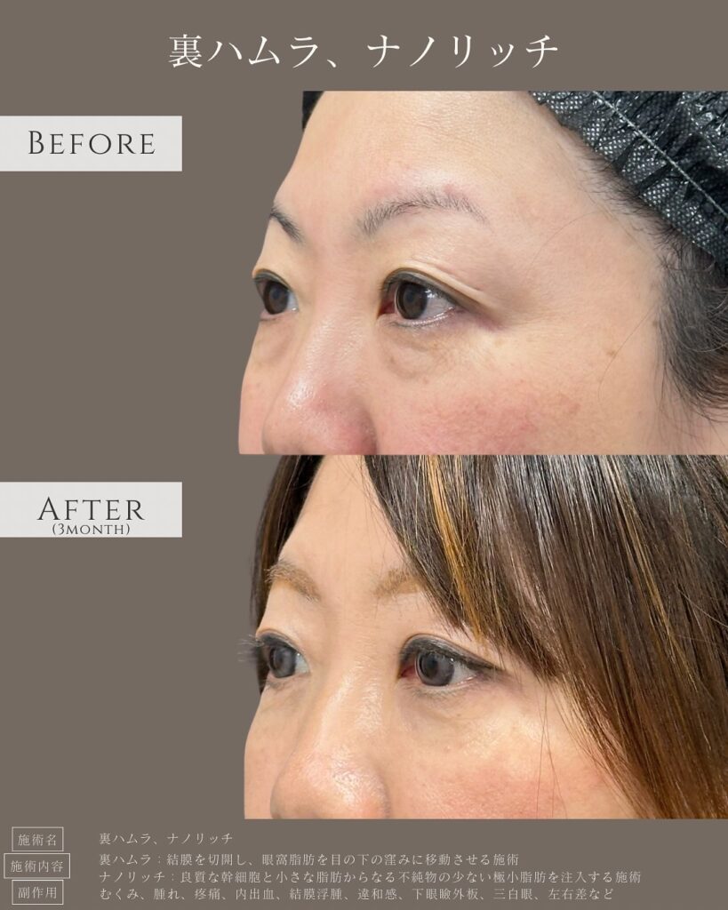 裏ハムラ法とナノリッチの症例写真 (7)