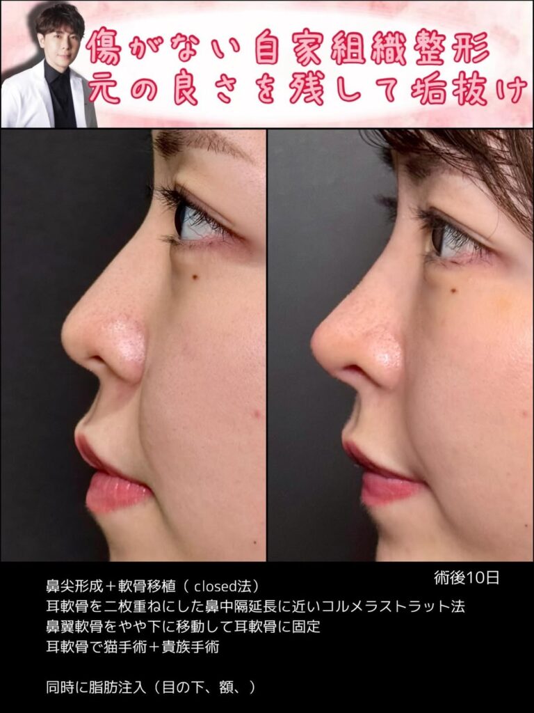 クローズド法の鼻尖形成と軟骨移植の症例写真 (5)
