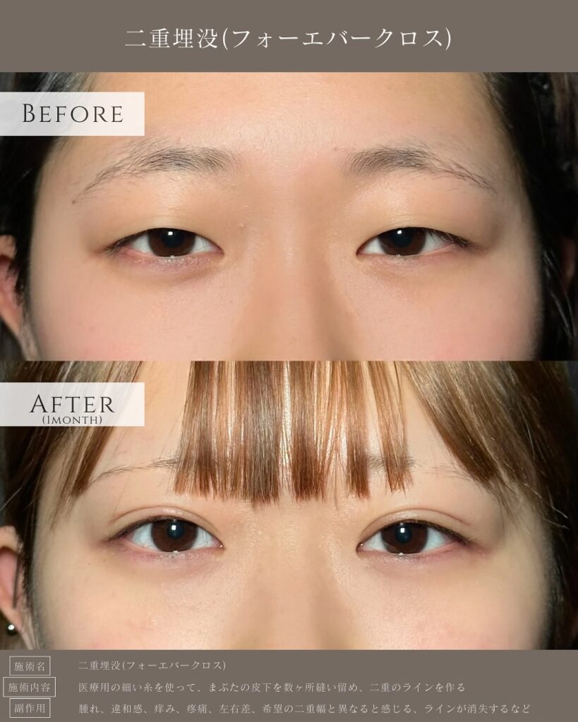 埋没法の症例写真 (9)