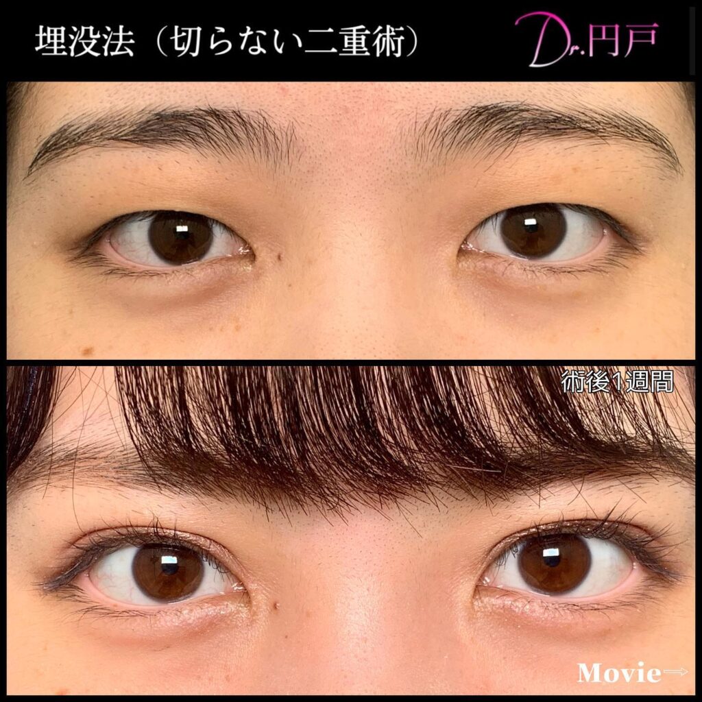 埋没法の症例写真 (9)