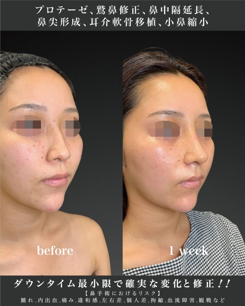 鼻のプロテーゼと鷲鼻修正と鼻中隔延長と鼻尖形成と耳介軟骨移植と小鼻縮小の症例写真