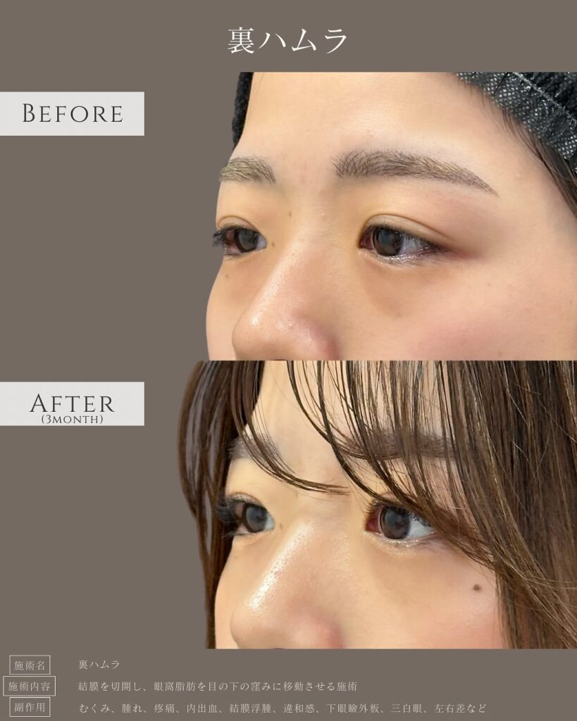 裏ハムラ法の症例写真 (18)