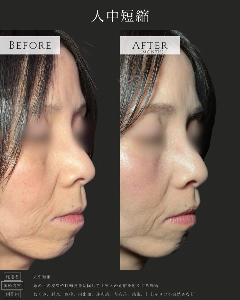 人中短縮の症例写真 (1)