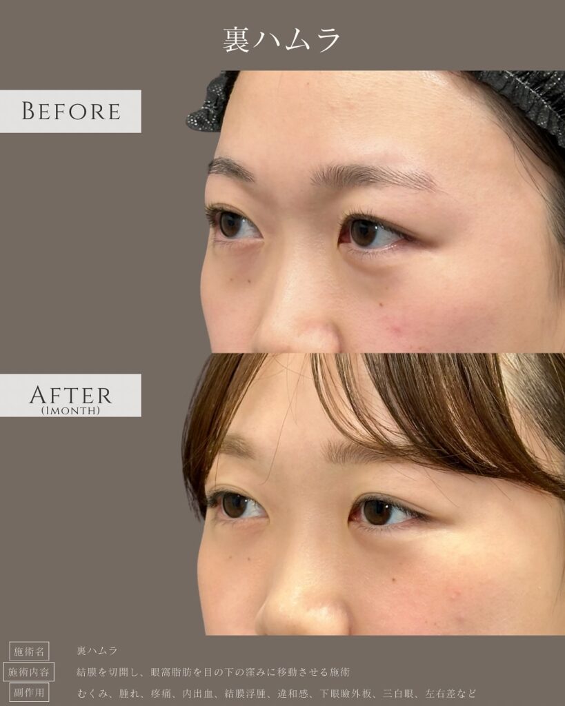 裏ハムラ法の症例写真 (25)