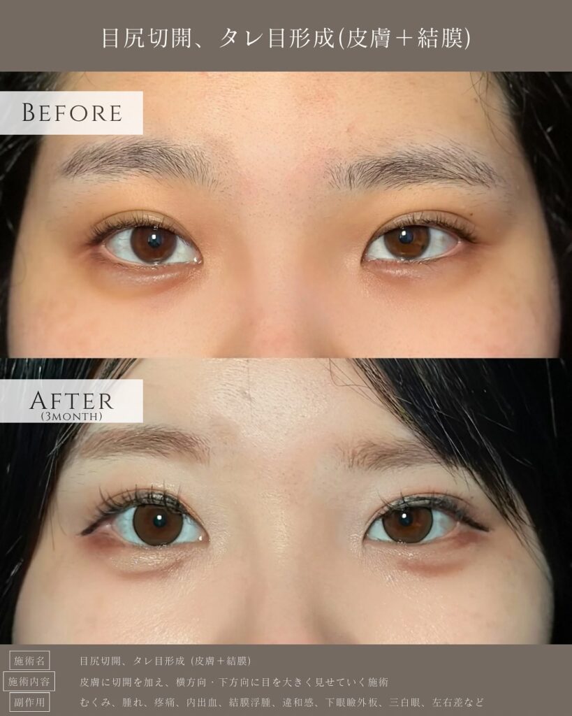 目尻切開とタレ目形成の症例写真 (12)