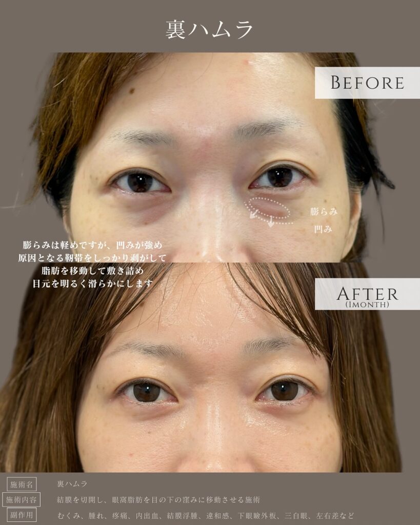 裏ハムラ法の症例写真 (6)