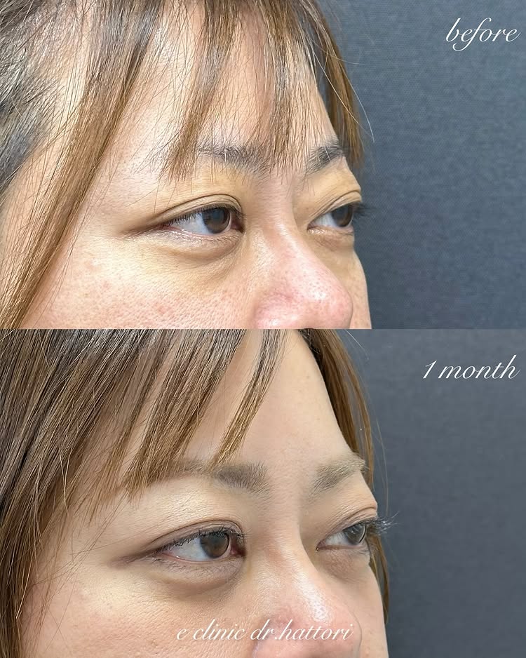 裏ハムラ法の症例写真 (58)