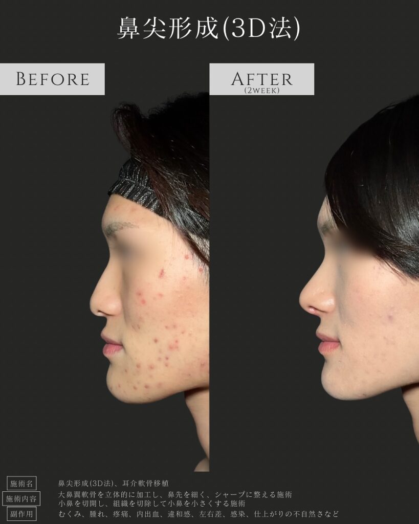 鼻尖形成と耳介軟骨移植の症例写真 (8)