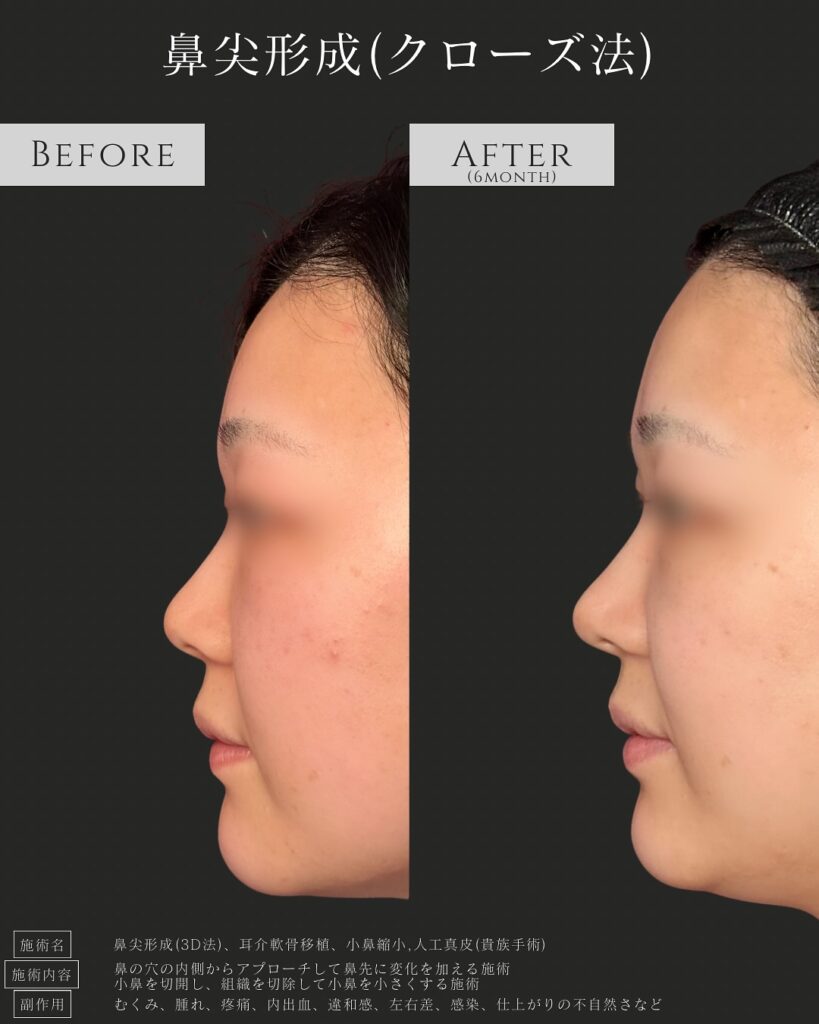鼻尖形成と耳介軟骨移植と小鼻縮小と貴族手術の症例写真 (1)
