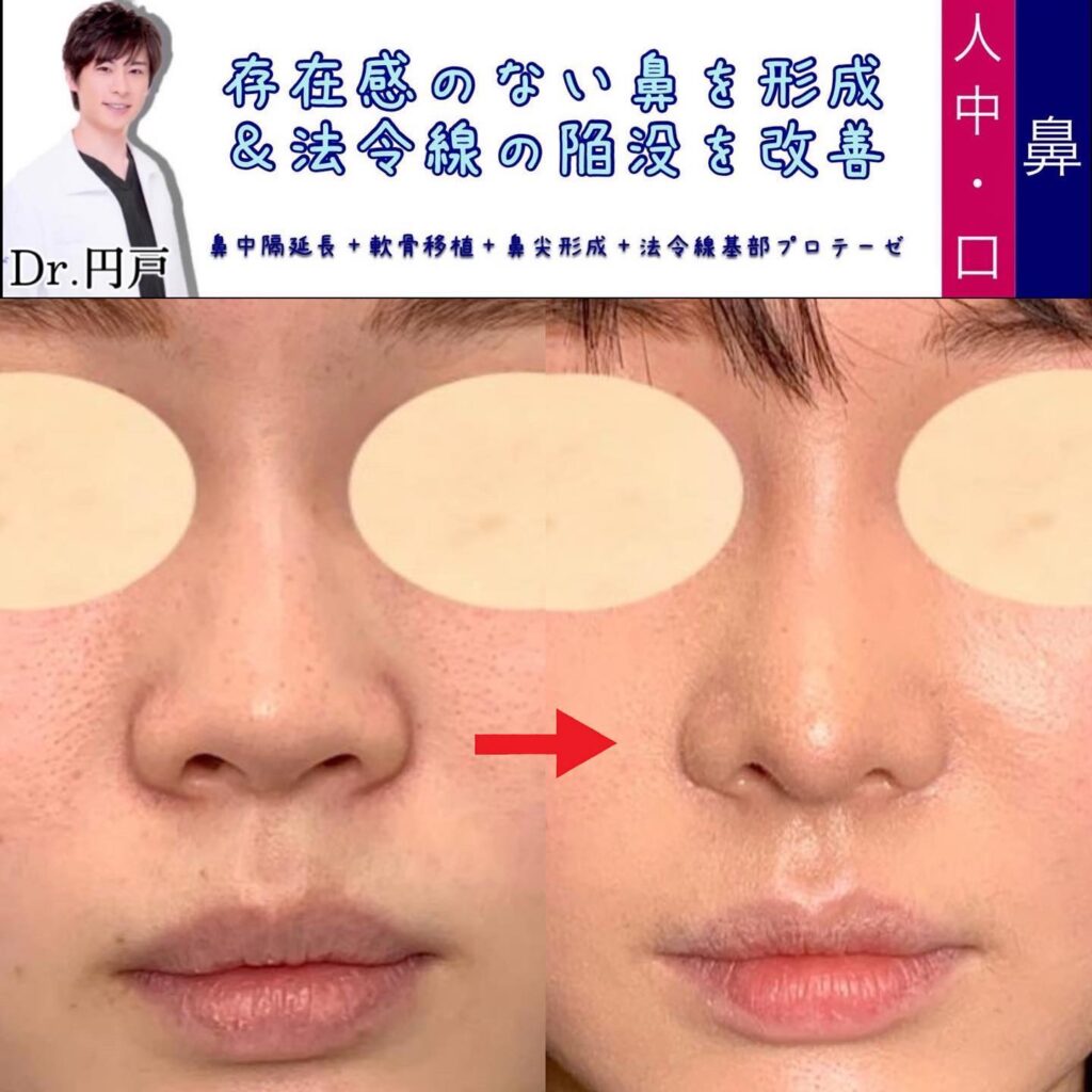 鼻中隔延長と軟骨移植お鼻尖形成と貴族手術の症例写真 (1)