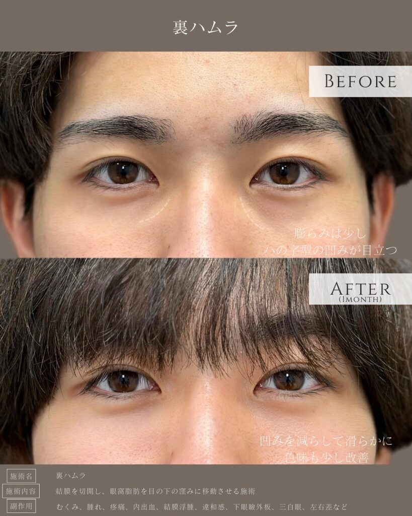裏ハムラ法を受けた男性の症例写真 (7)
