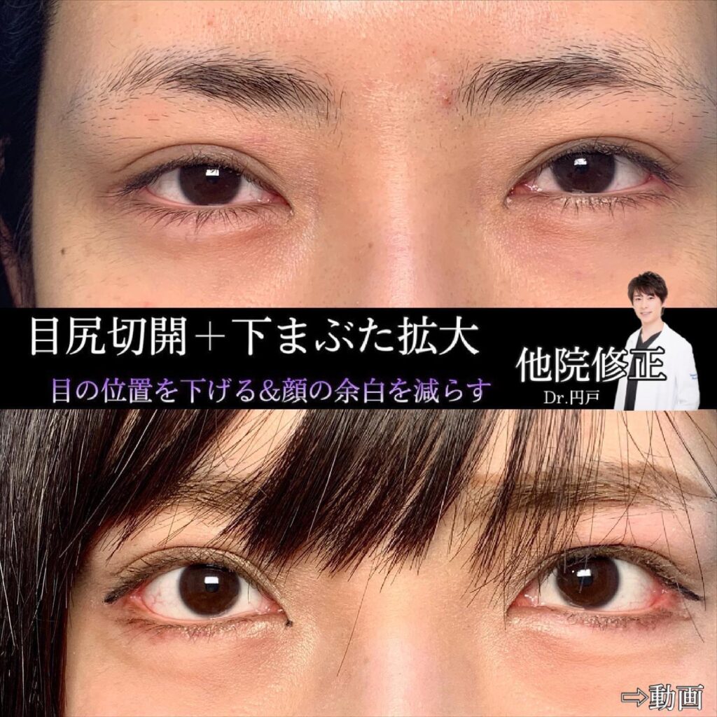 タレ目形成+目尻切開、タレ目尻の他院修正の症例写真