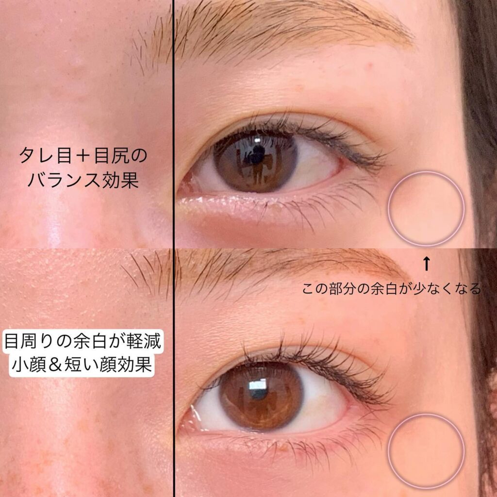 目尻切開と下瞼拡大の症例写真 (5)