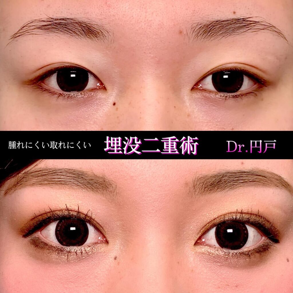 埋没法の症例写真 (19)