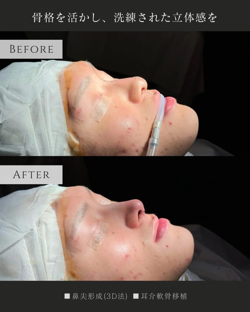 鼻尖形成と耳介軟骨移植の症例写真 (11)