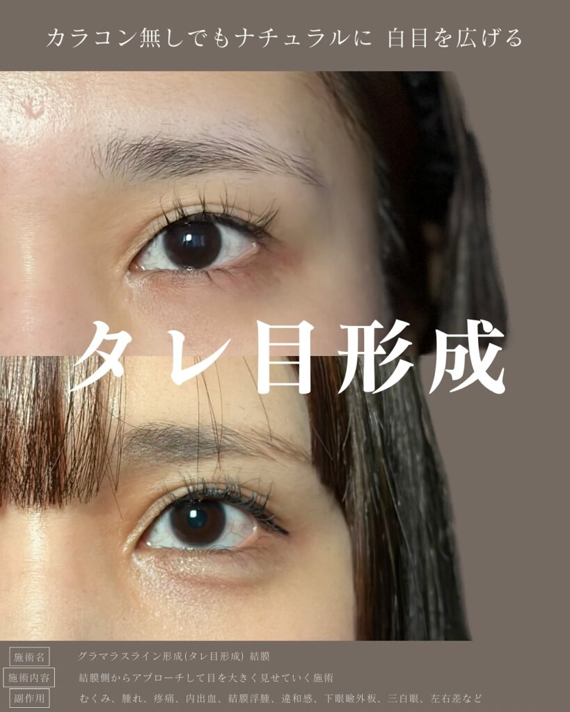 タレ目形成の症例写真 (23)