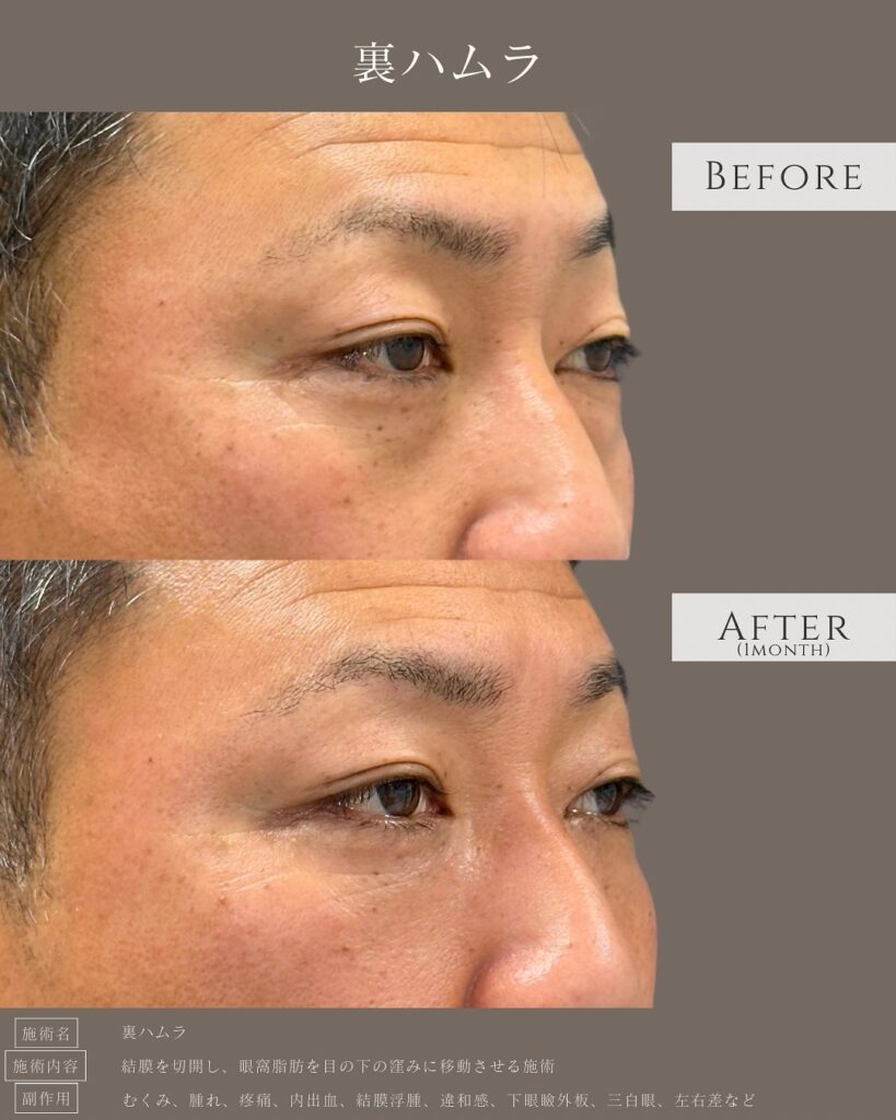 裏ハムラ法を受けた男性の症例写真 (2)