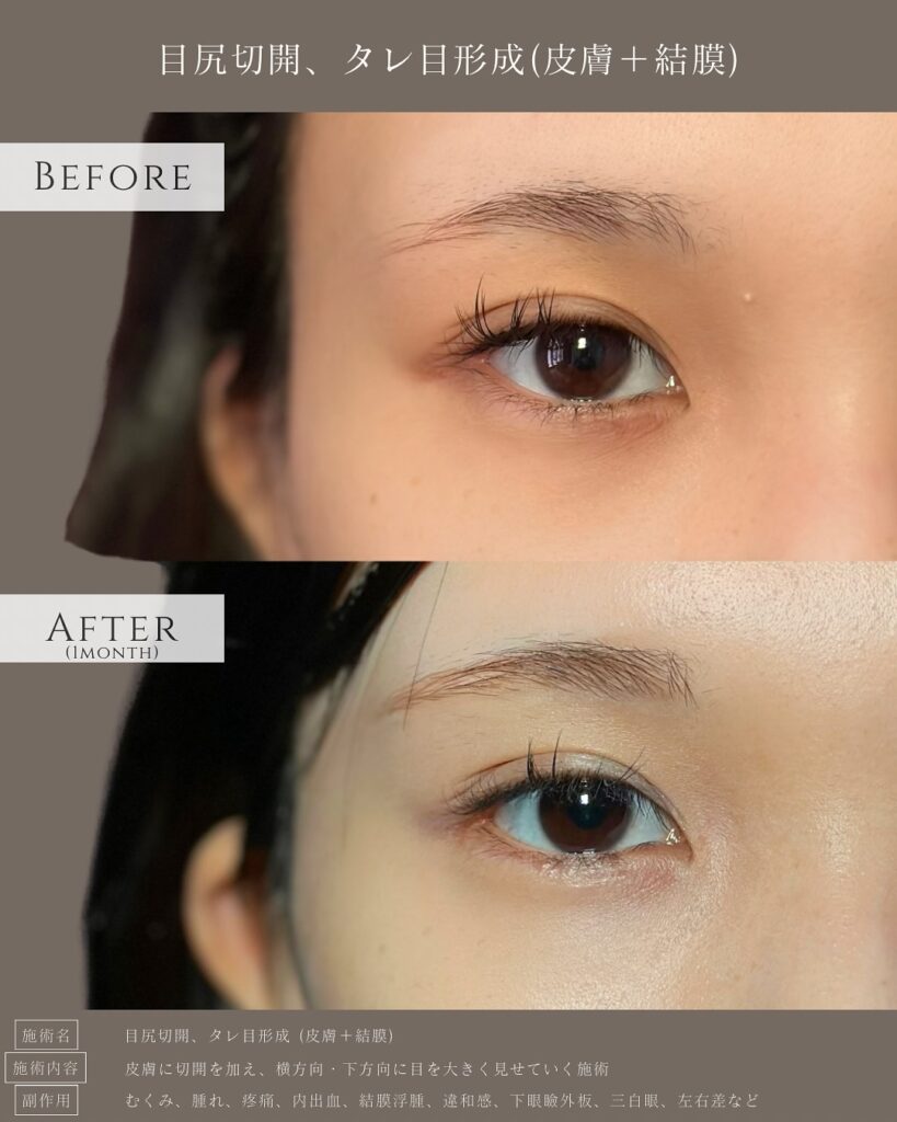 目尻切開とタレ目形成の症例写真 (27)
