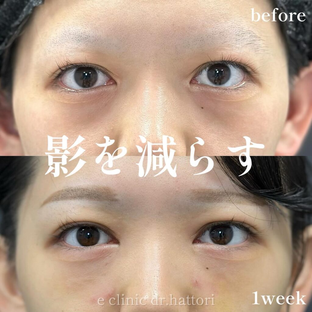 裏ハムラ法の症例写真 (73)