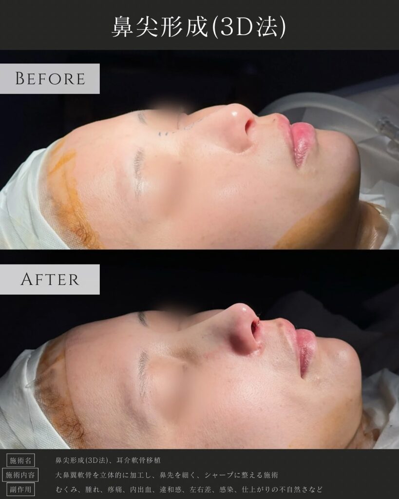 鼻尖形成と耳介軟骨移植の症例写真 (33)