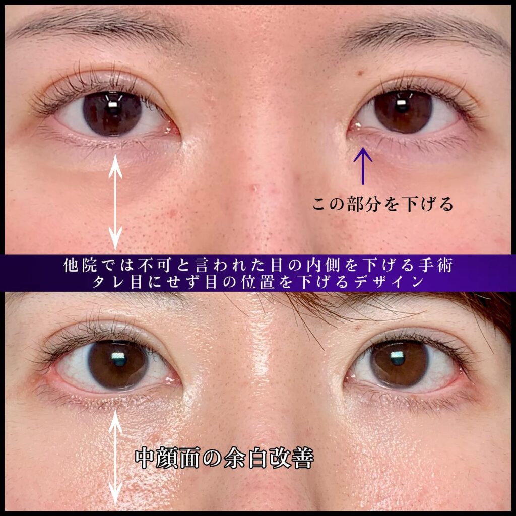下瞼形成と目尻靭帯移動の症例写真 (1)