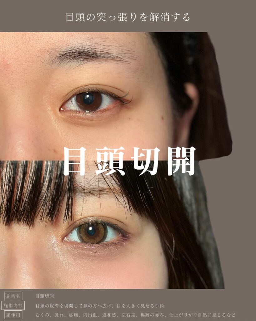 目頭切開の症例写真 (1)