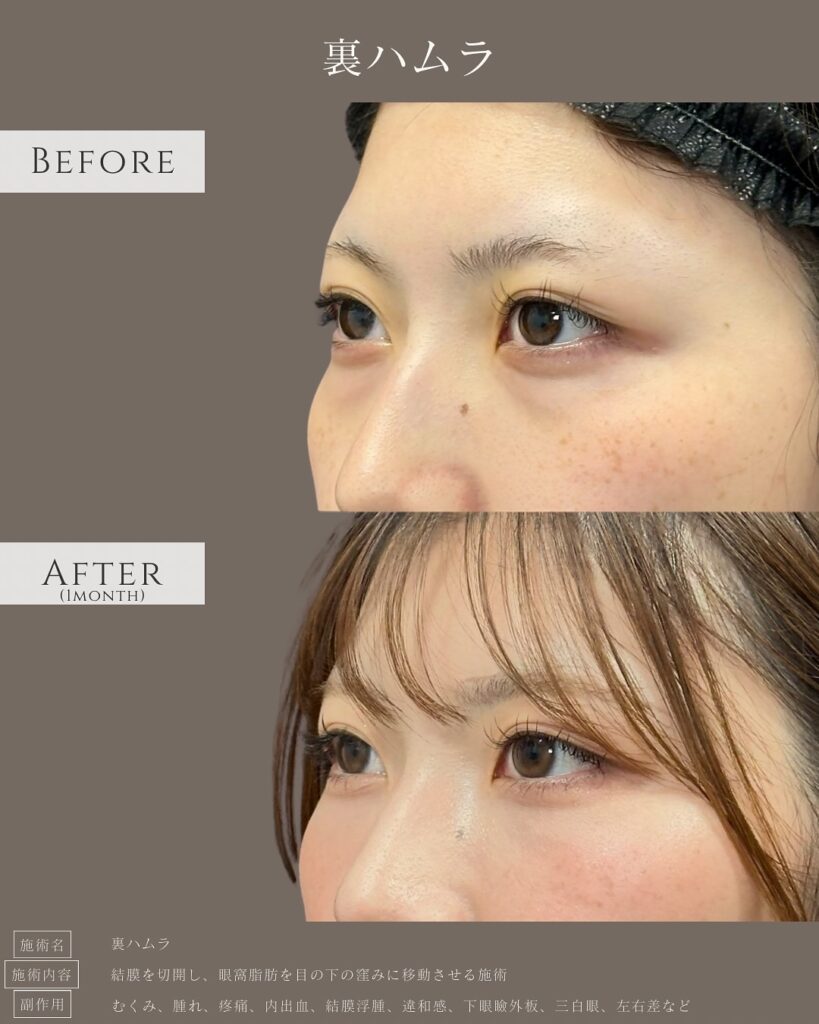 裏ハムラ法の症例写真 (21)