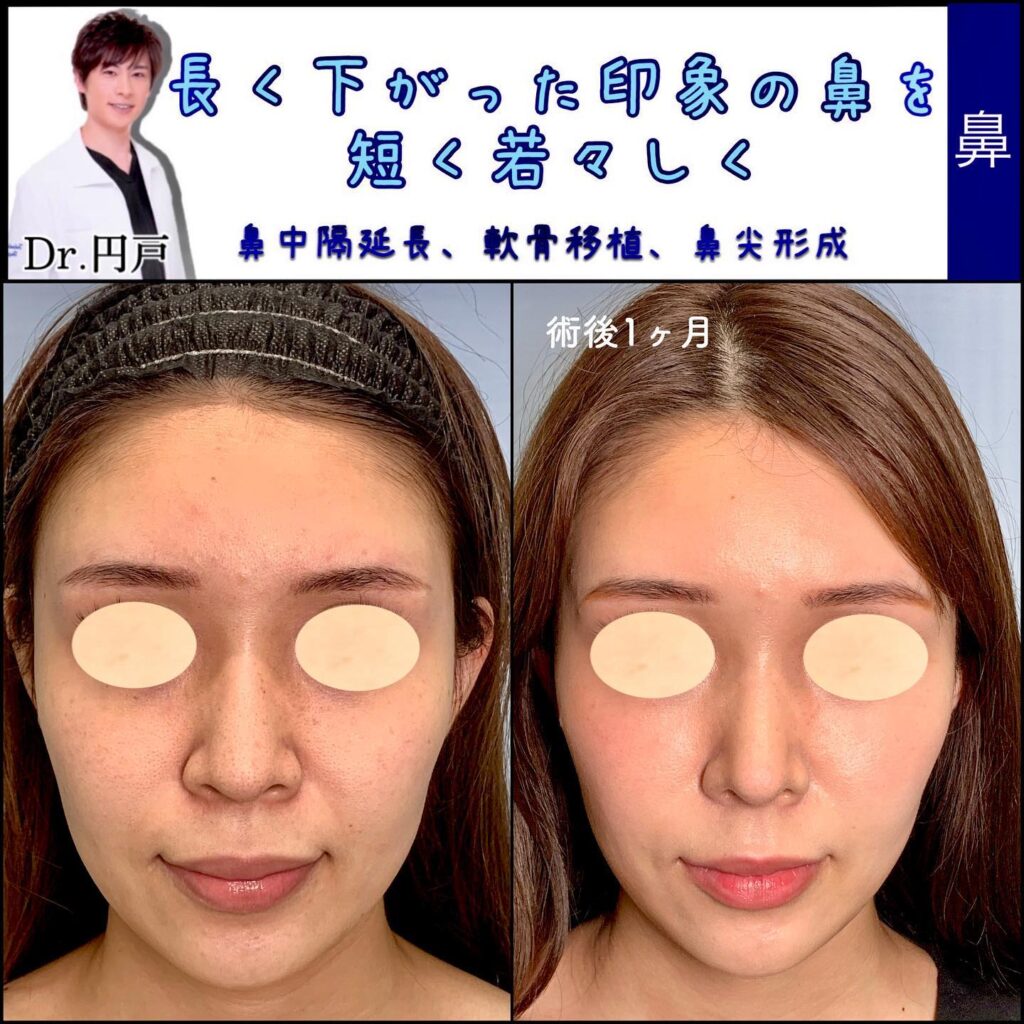 鼻中隔延長と軟骨移植と鼻尖形成の症例写真 (2)