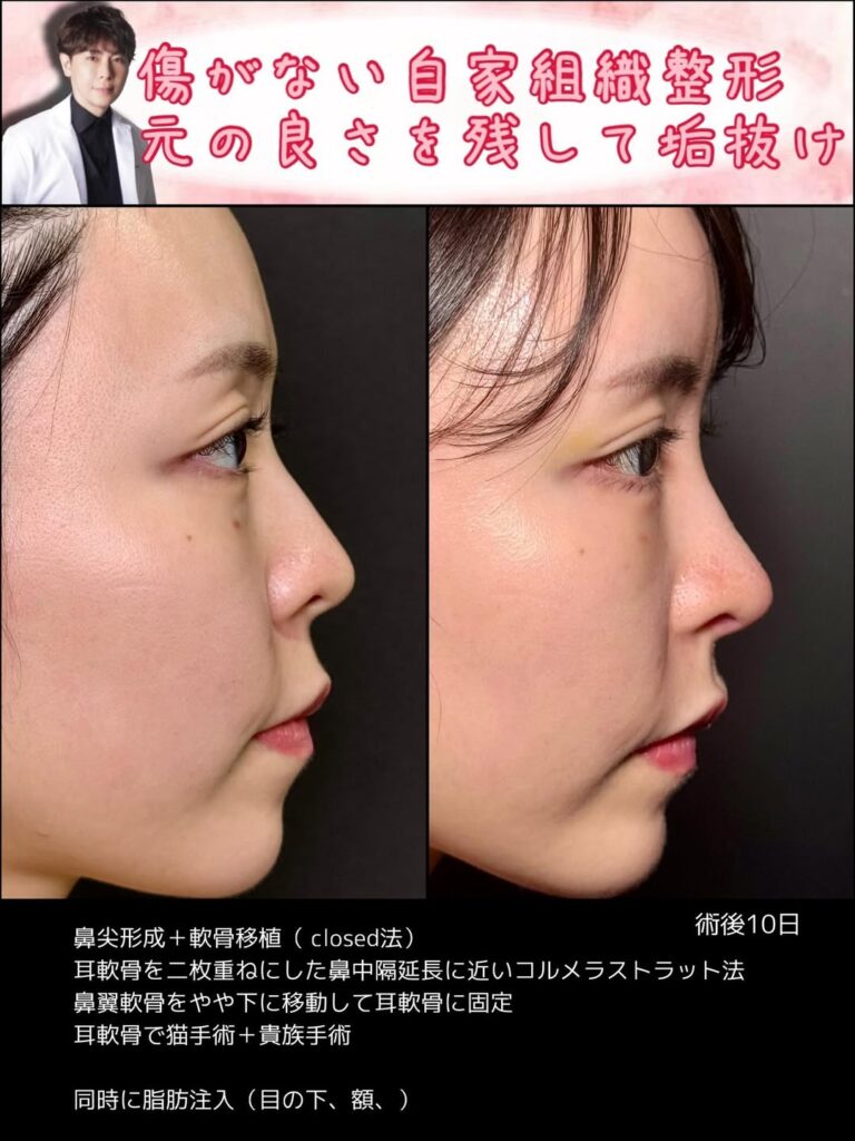 クローズド法の鼻尖形成と軟骨移植の症例写真 (7)