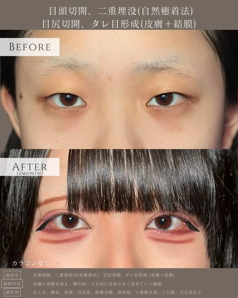 目頭切開と埋没法と目尻切開とタレ目形成の症例写真 (2)
