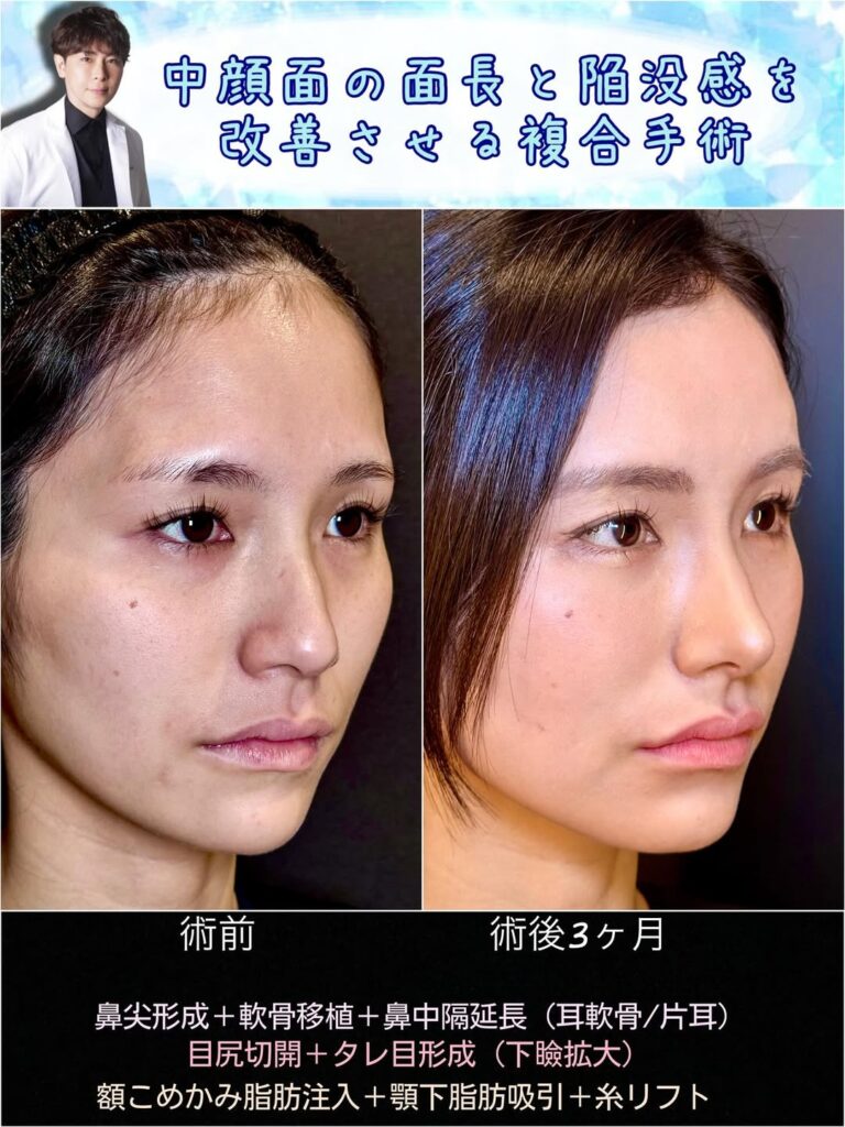 鼻尖形成と軟骨移植と鼻中隔延長と目尻切開とタレ目形成と脂肪注入と顎下の脂肪吸引とヒアルロン酸の症例写真 (3)