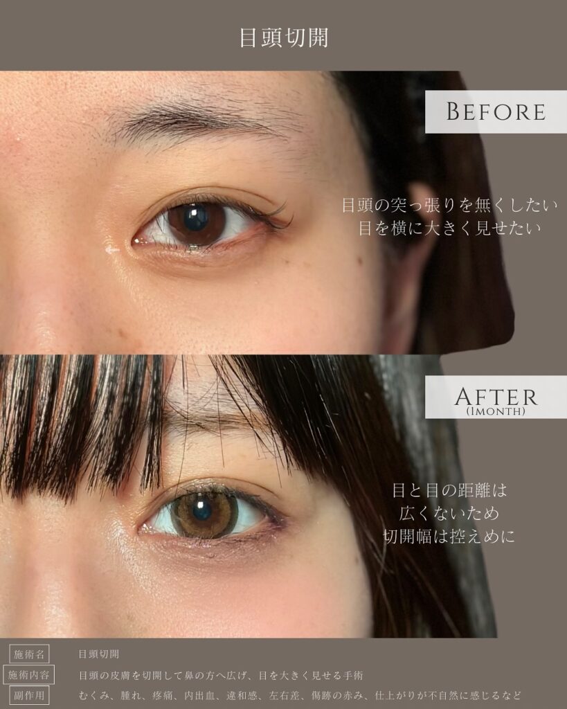 目頭切開の症例写真 (4)