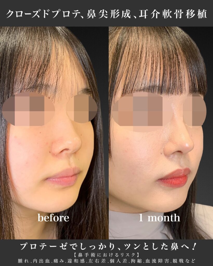 鼻のプロテーゼと鼻尖形成と耳介軟骨移植の症例写真