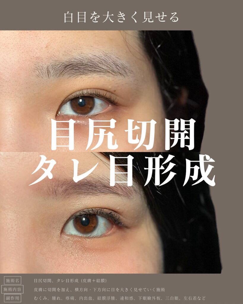 目尻切開とタレ目形成の症例写真 (35)