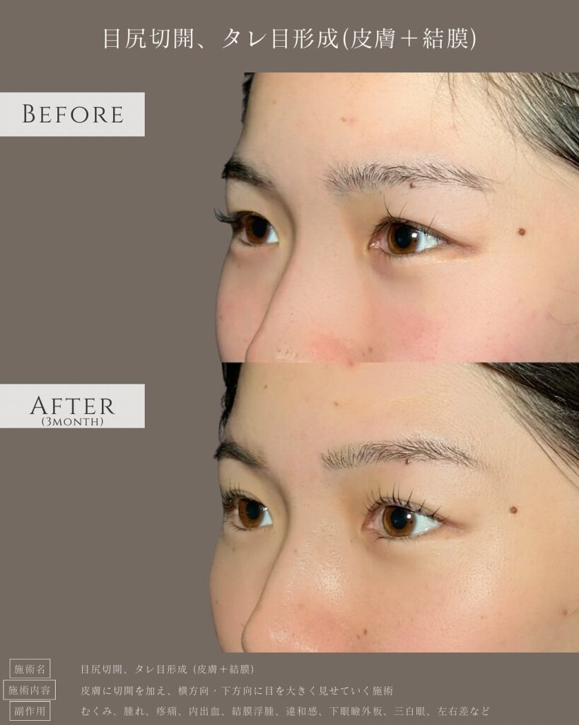 目尻切開とタレ目形成の症例写真 (18)