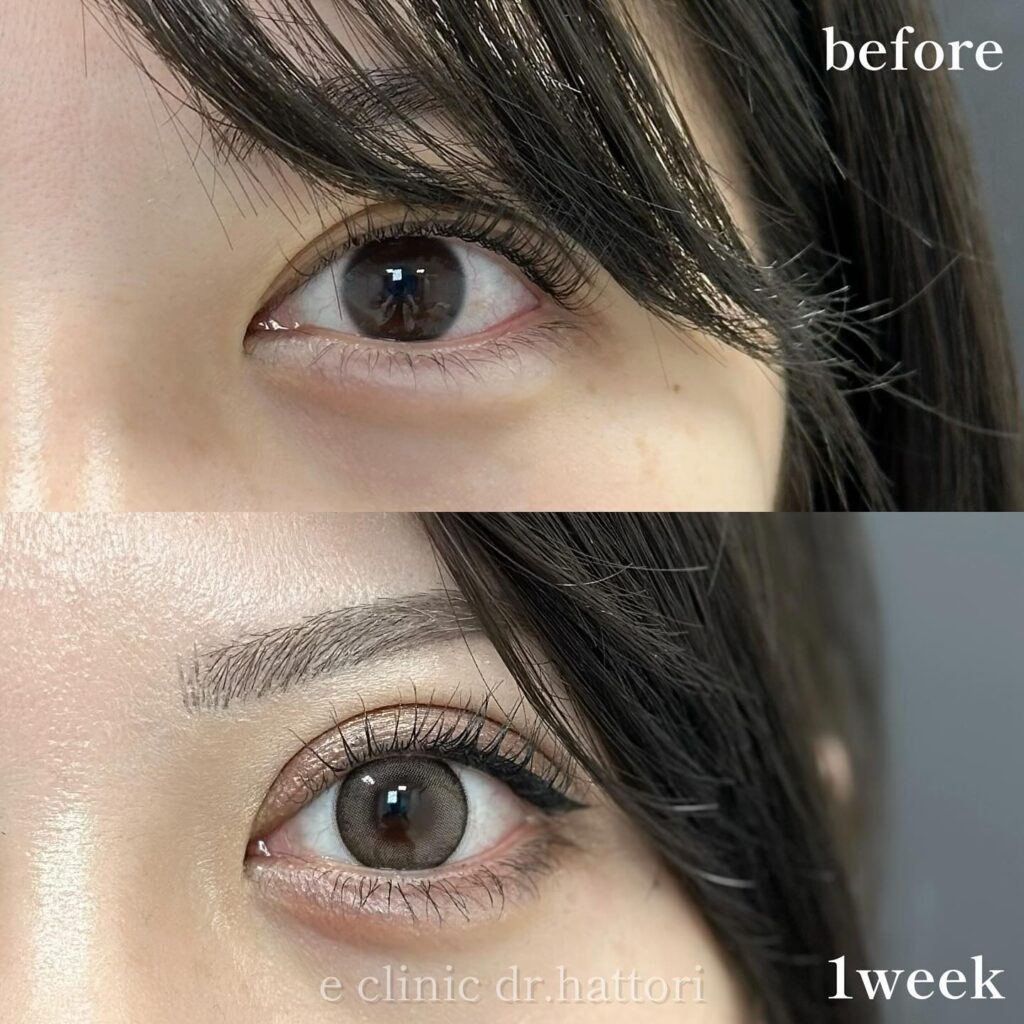 自然癒着法の症例写真 (20)