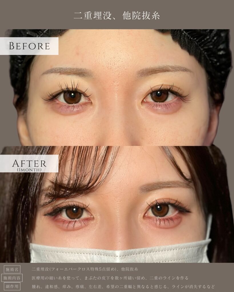 埋没法と他院抜糸の症例写真 (2)