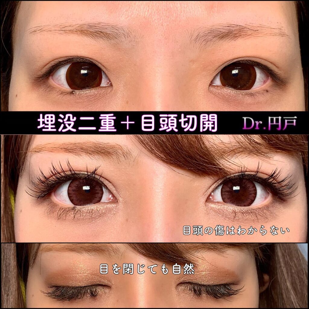 埋没法と目頭切開の症例写真 (2)