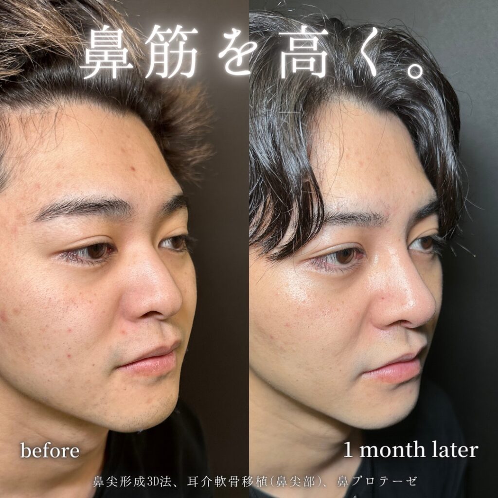 伊藤渉医師が行った男性の鼻尖形成とプロテーゼと耳介軟骨移植の1か月後の男性の症例