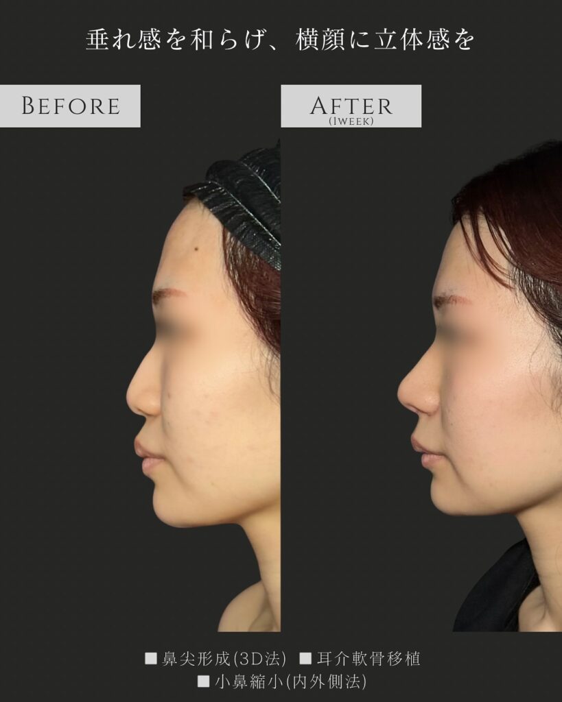 鼻尖形成と耳介軟骨移植と小鼻縮小の症例写真 (5)