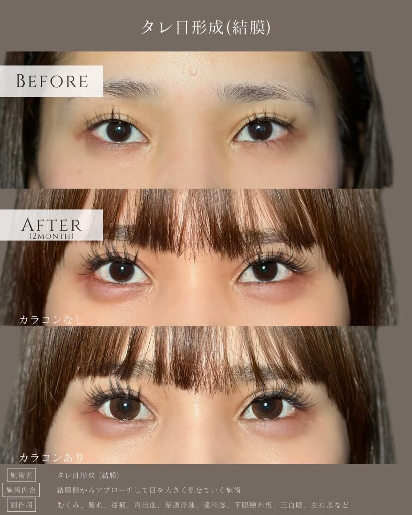 タレ目形成の症例写真 (16)