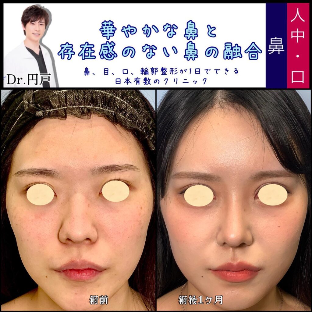 鼻中隔延長と軟骨移植とプロテーゼと脂肪注入と輪郭形成の症例写真 (3)