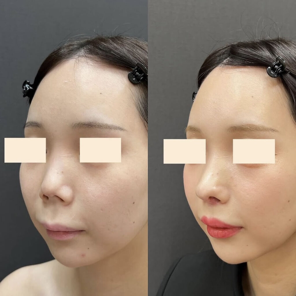 ４回目の肋軟骨の修正手術の斜め向きの症例写真