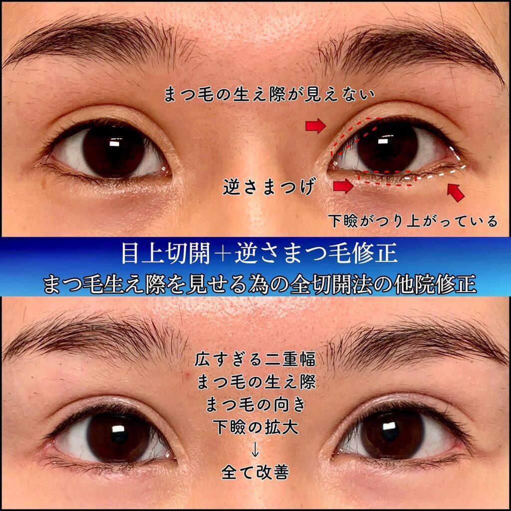 全切開の他院修正と下瞼拡大と逆さまつげ修正の症例写真 (2)