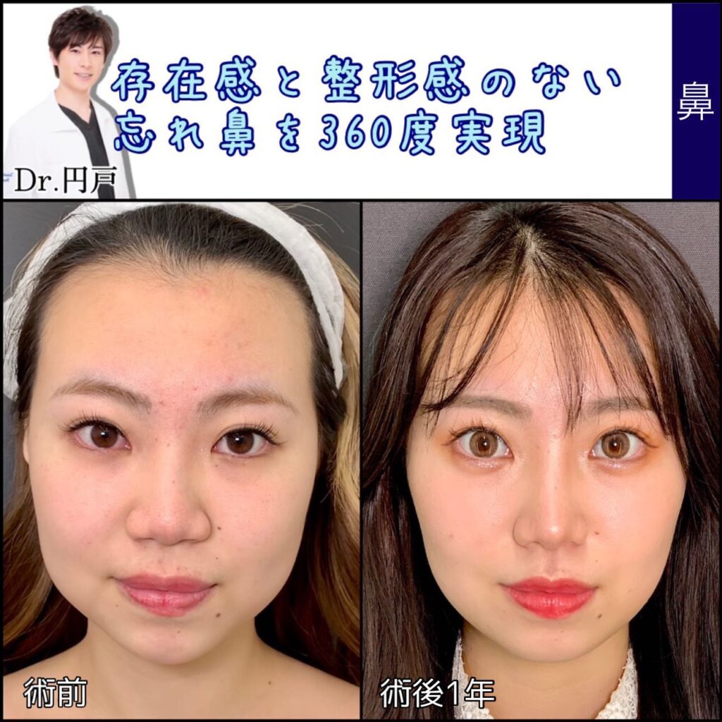 鼻尖形成+軟骨移植+鼻中隔延長、法令線基部人口真皮、鼻背部軟骨以上、小鼻縮小を同時に行った症例写真