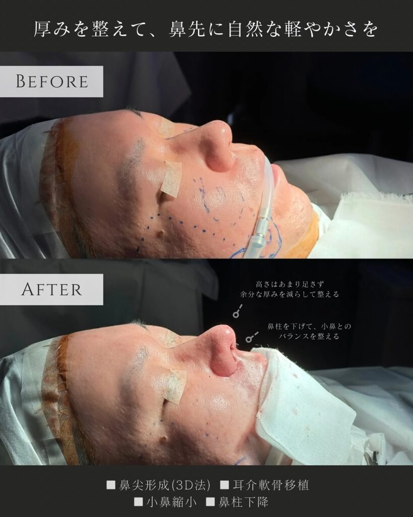 鼻尖形成と耳介軟骨移植と小鼻縮小と鼻柱下降の症例写真 (3)
