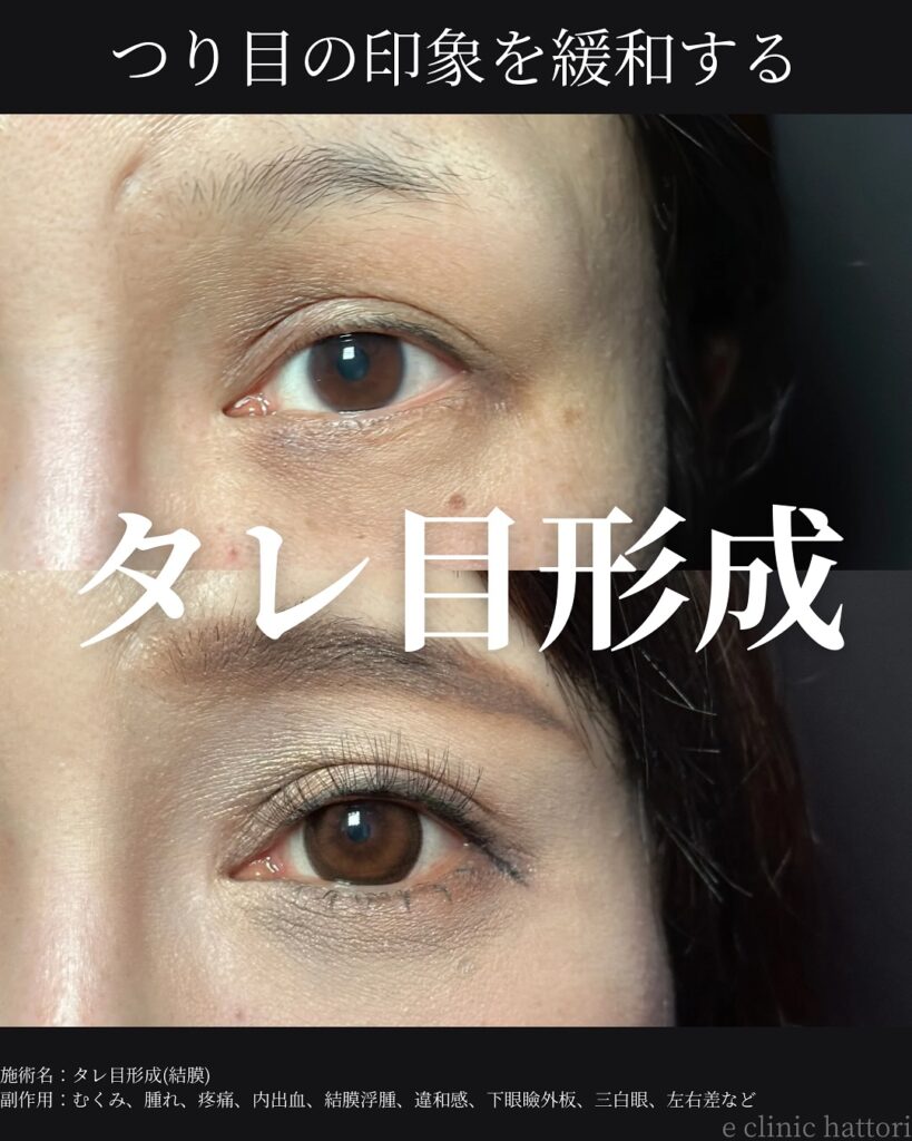 タレ目形成の症例写真 (28)